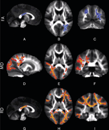 Image: These brain images, captured with DTI MRI, show water diffusion within the white matter of children with sensory-processing disorders (SPDs). Row FA: The blue areas show white matter where water diffusion was less directional than in typical children, indicating impaired white matter microstructure. Row MD: The red areas show white matter where the overall rate of water diffusion was higher than in typical children, also indicating abnormal white matter. Row RD: The red areas show white matter where SPD children have higher rates of water diffusion perpendicular to the axonal fibers, indicating a loss of integrity of the fiber bundles comprising the white matter tracts (Photo courtesy of the University of California, San Francisco - UCSF). Image: These brain images, captured with DTI MRI, show water diffusion within the white matter of children with sensory-processing disorders (SPDs). Row FA: The blue areas show white matter where water diffusion was less directional than in typical children, indicating impaired white matter microstructure. Row MD: The red areas show white matter where the overall rate of water diffusion was higher than in typical children, also indicating abnormal white matter. Row RD: The red areas show white matter where SPD children have higher rates of water diffusion perpendicular to the axonal fibers, indicating a loss of integrity of the fiber bundles comprising the white matter tracts (Photo courtesy of the University of California, San Francisco - UCSF).